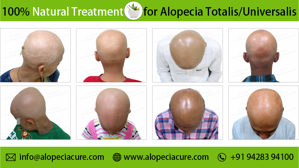 alopecia totalis treatment